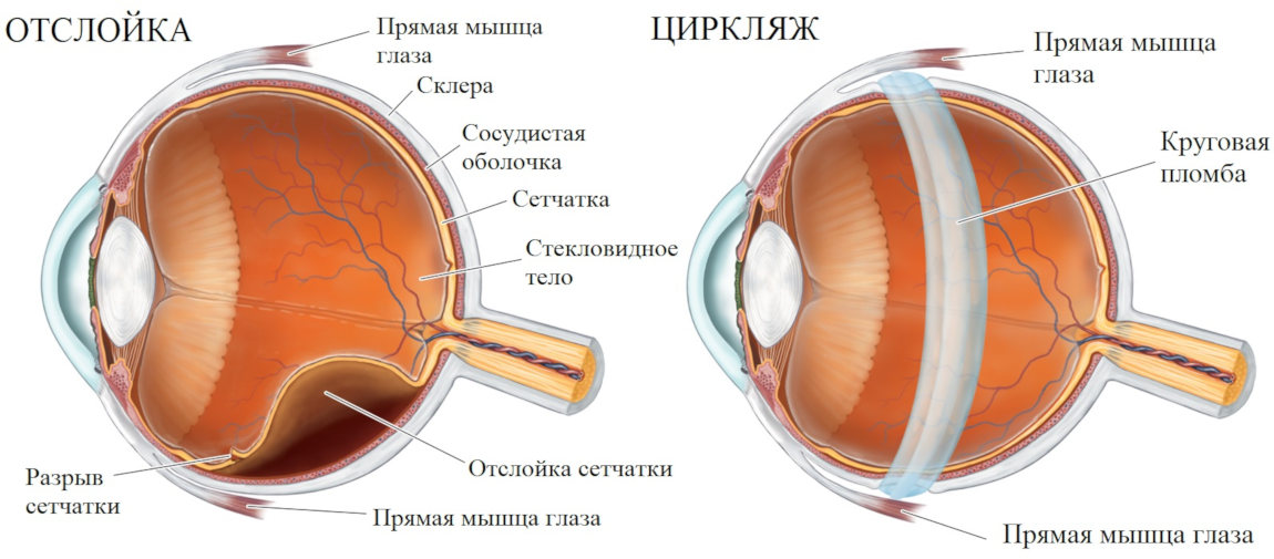 Циркляж глаза что это. Смотреть фото Циркляж глаза что это. Смотреть картинку Циркляж глаза что это. Картинка про Циркляж глаза что это. Фото Циркляж глаза что это