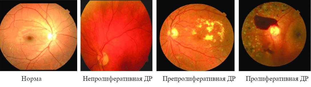 Классификация и стадии диабетической ретинопатии