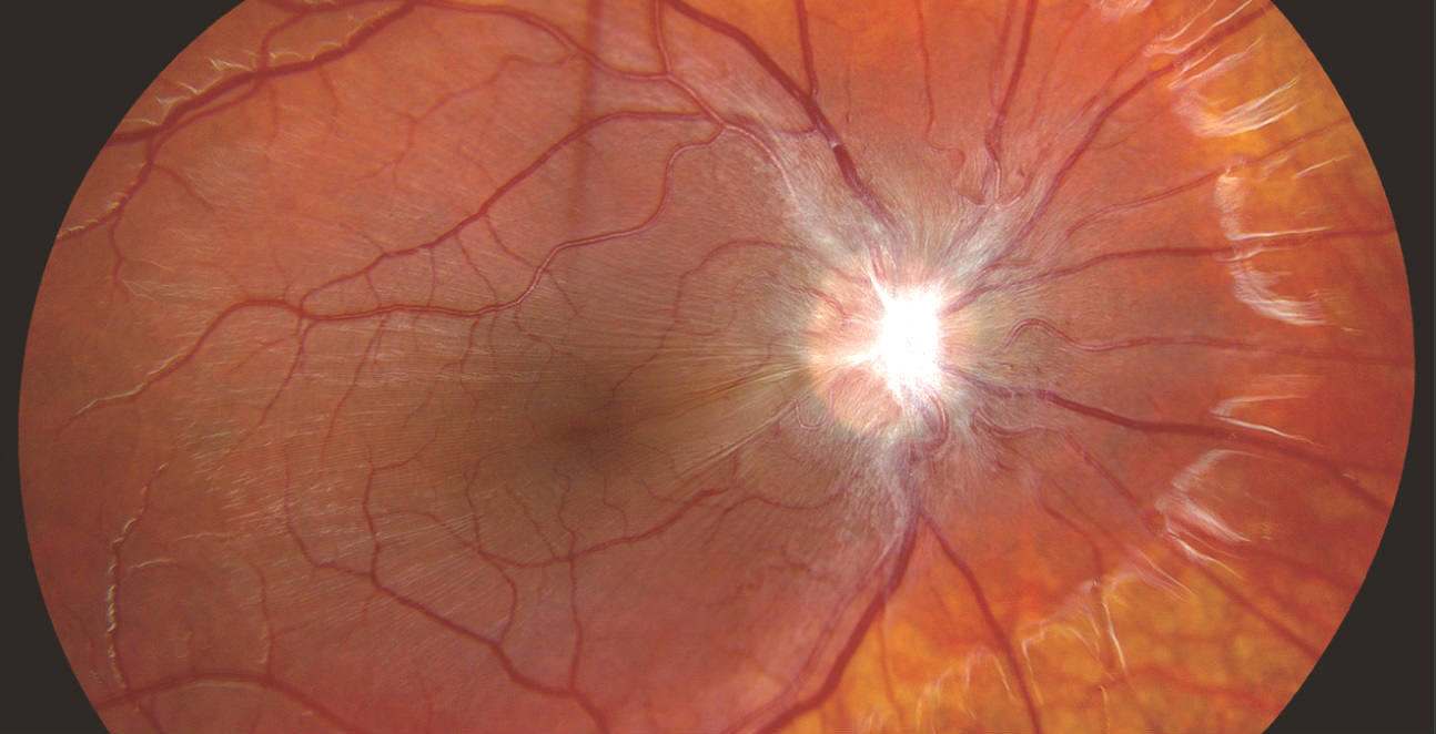 Целлофановая (эпиретинальная) мембрана сетчатки глаза или макулярный фиброз