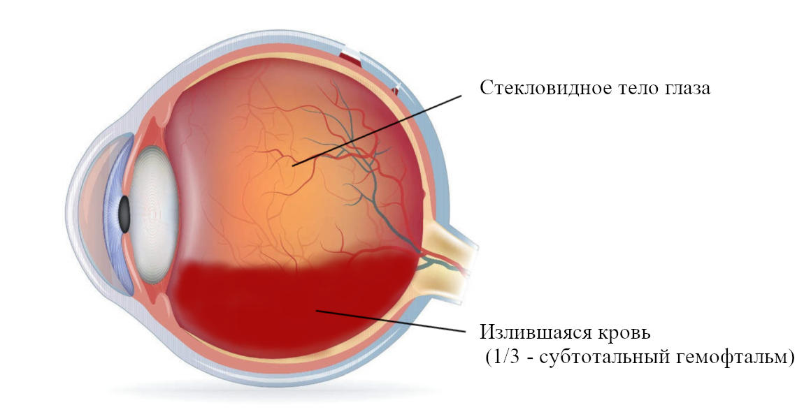 Стекловидное тело фото