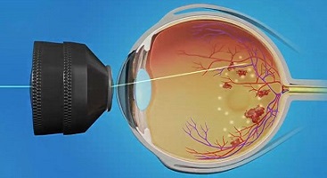 Диагностика и лечение дистрофий сетчатки глаза в Москве