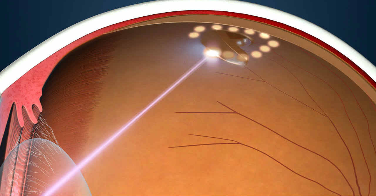Лазерное лечение сетчатки глаза в Москве, стоимость лазерной коагуляции сетчатки, ППЛК