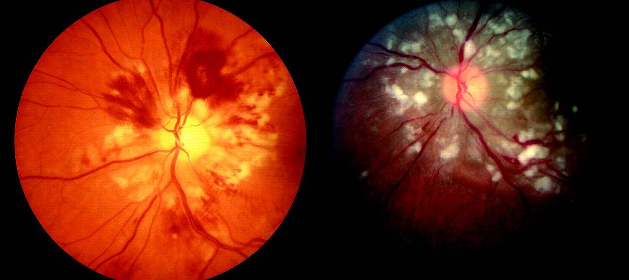 Ангиопатия сетчатки глаза - диагностика и лечение