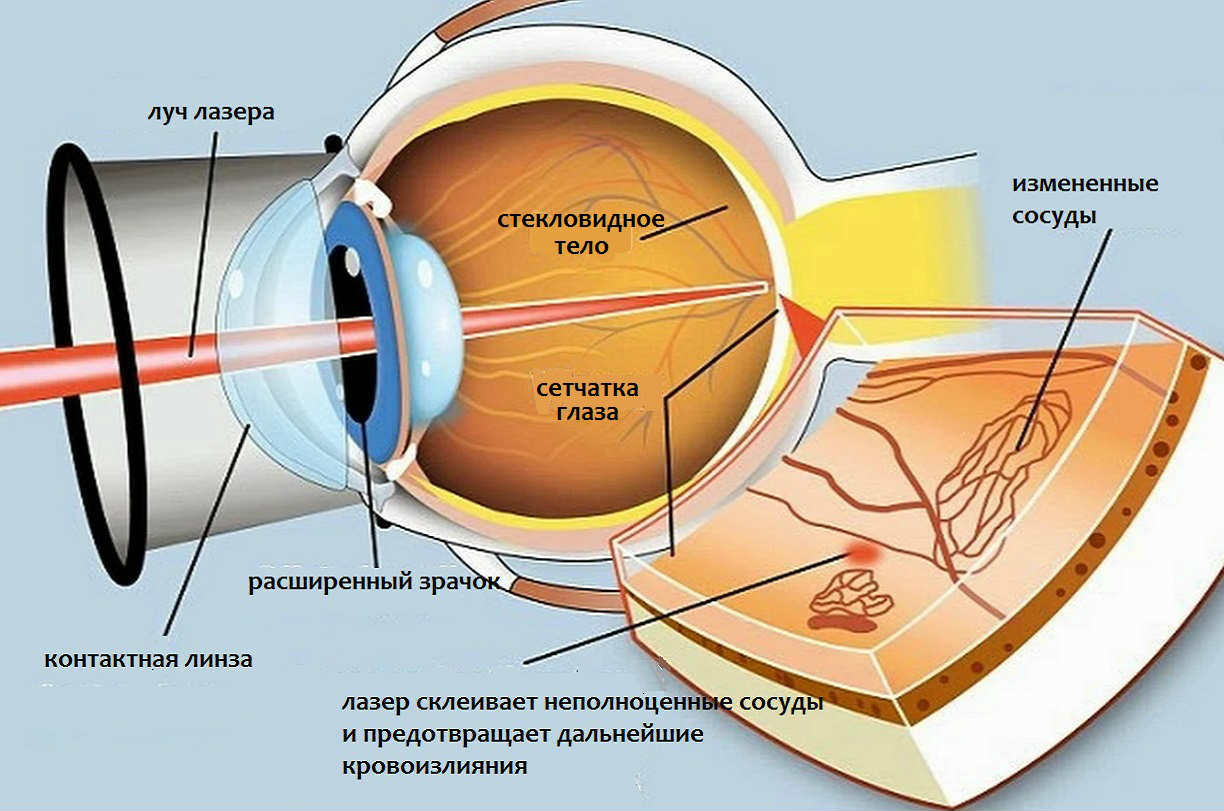 Лечение диабетической ретинопатии в Москве отзывы