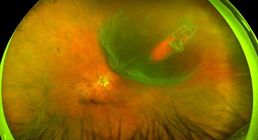 Лечение разрывов сетчатки глаза