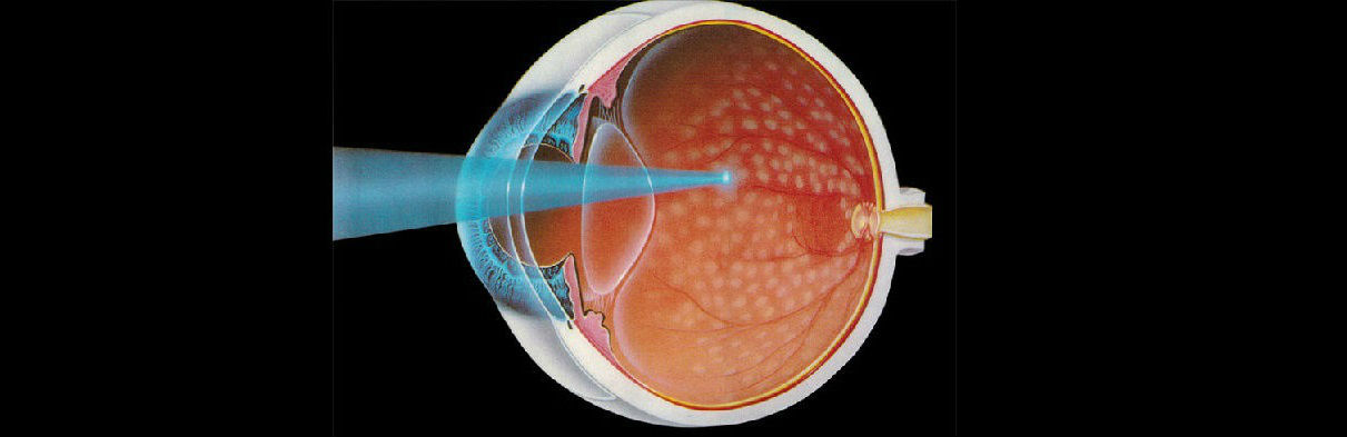Лечение после лазерной коагуляции сетчатки глаза thumbnail