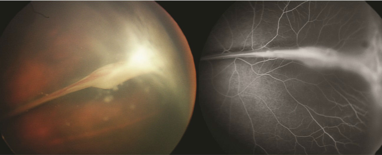 Как проявляется пролиферативная витреоретинопатия сетчатки глаза