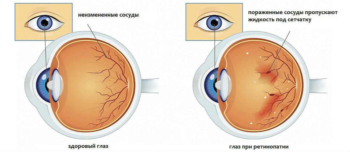 Ретинопатия сетчатки глаза что это и почему развивается