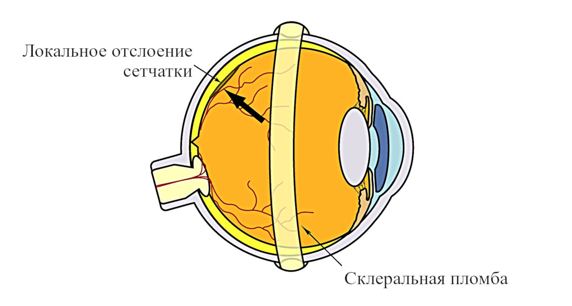 Эписклеральное пломбирование - операция при отслоении сетчатки глаза
