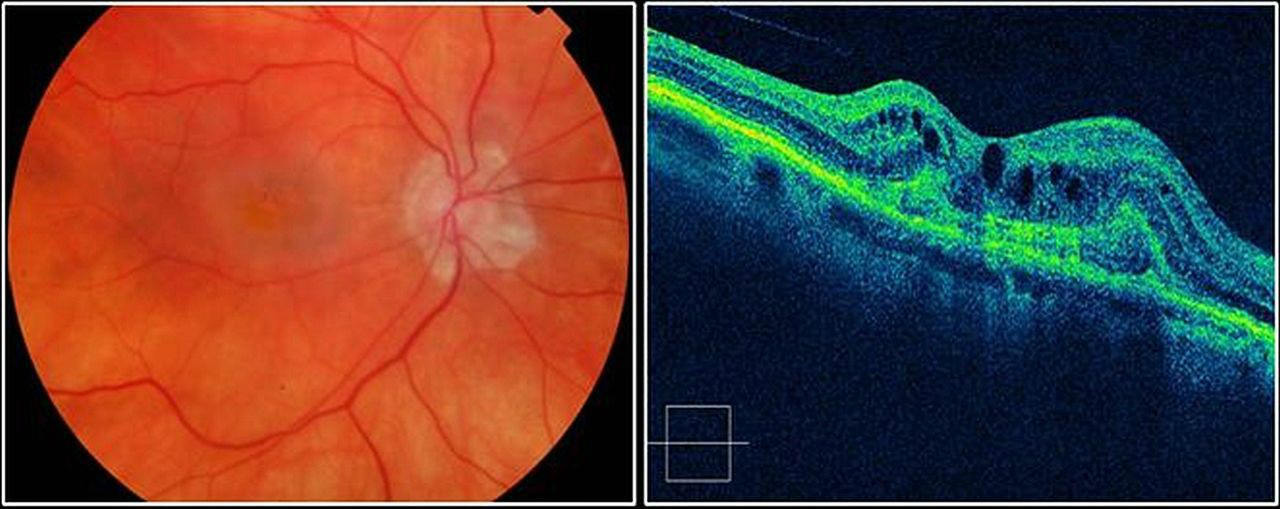 Субретинальная неоваскулярная мембрана глаза почему появляется