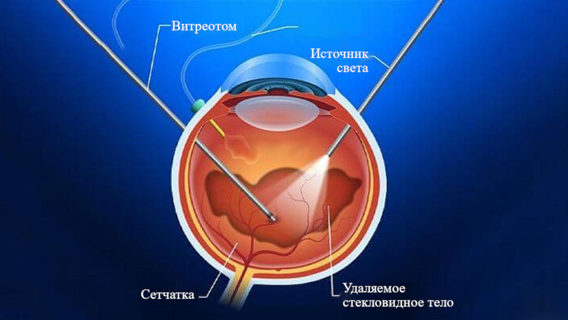 Операция микроинвазивная витрэктомия при отслоении сетчатки глаза