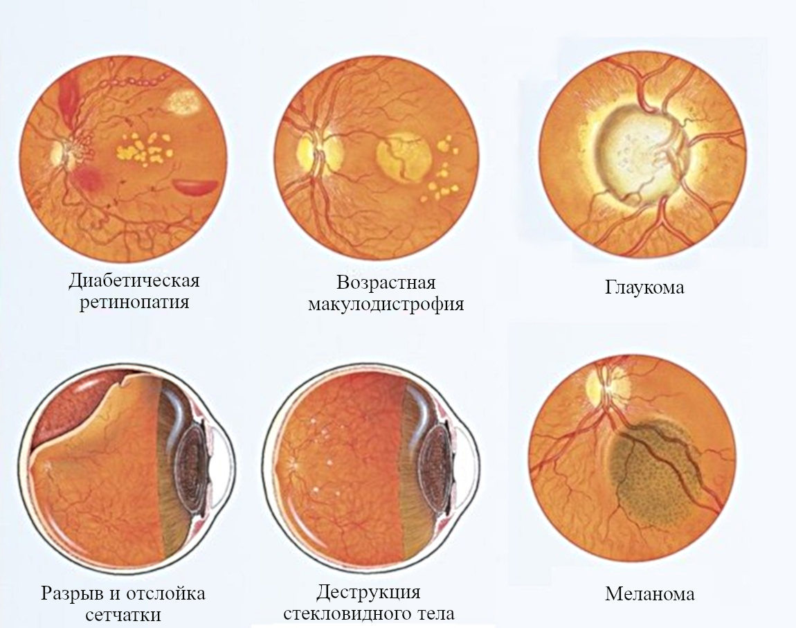 Картина глазного дна при различных заболеваниях