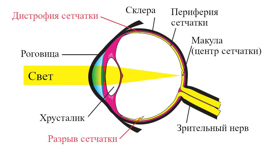 Лазерное укрепление сетчатки глаза при дистрофиях и разрывах
