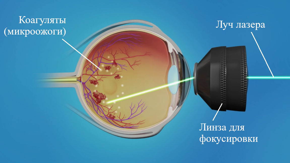 Схема лазерных операций на сетчатке глаза