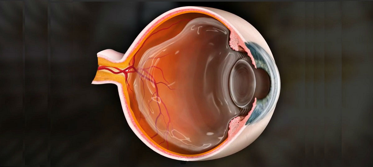 Отслойка задней гиалоидной мембраны глаза причины и симптомы