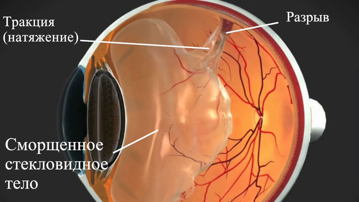Причины развития разрыва сетчатки глаза