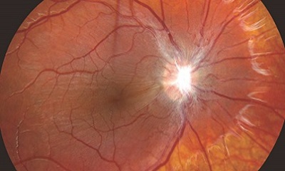 Эпиретинальная мембрана (фиброз) сетчатки глаза