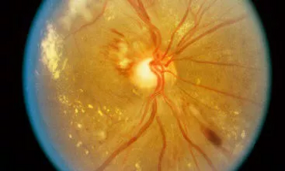 Гипертоническая ретинопатия сетчатки глаза