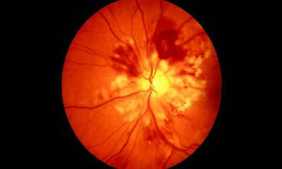 Лечение ангиопатий сетчатки глаза