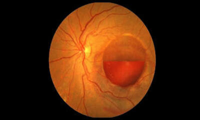 Лечение ретинального кровоизлияния (в сетчатку)