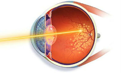 Ограничительная лазерная коагуляция сетчатки глаза