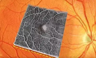ОКТ-ангиография сетчатки глаза