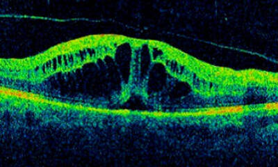 Отечная макулопатия сетчатки глаза при диабете