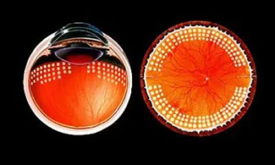 Профилактическая периферическая лазерная коагуляция (ППЛК) сетчатки глаза