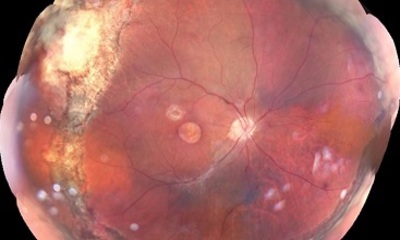 Пролиферативная витреоретинопатия сетчатки глаза — причины и лечение