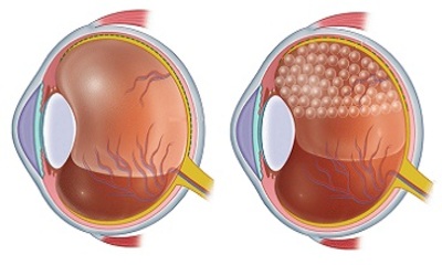 Тампонада сетчатки глаза: силиконовая и воздушная