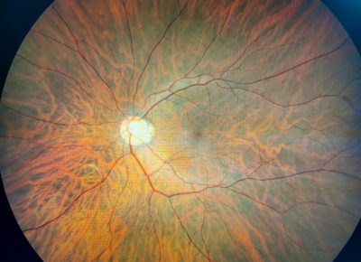 Пигментный ретинит глаза: патогенез, признаки и направления лечения