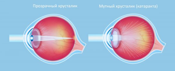 Причины катаракты - как мутнеет хрусталик глаза