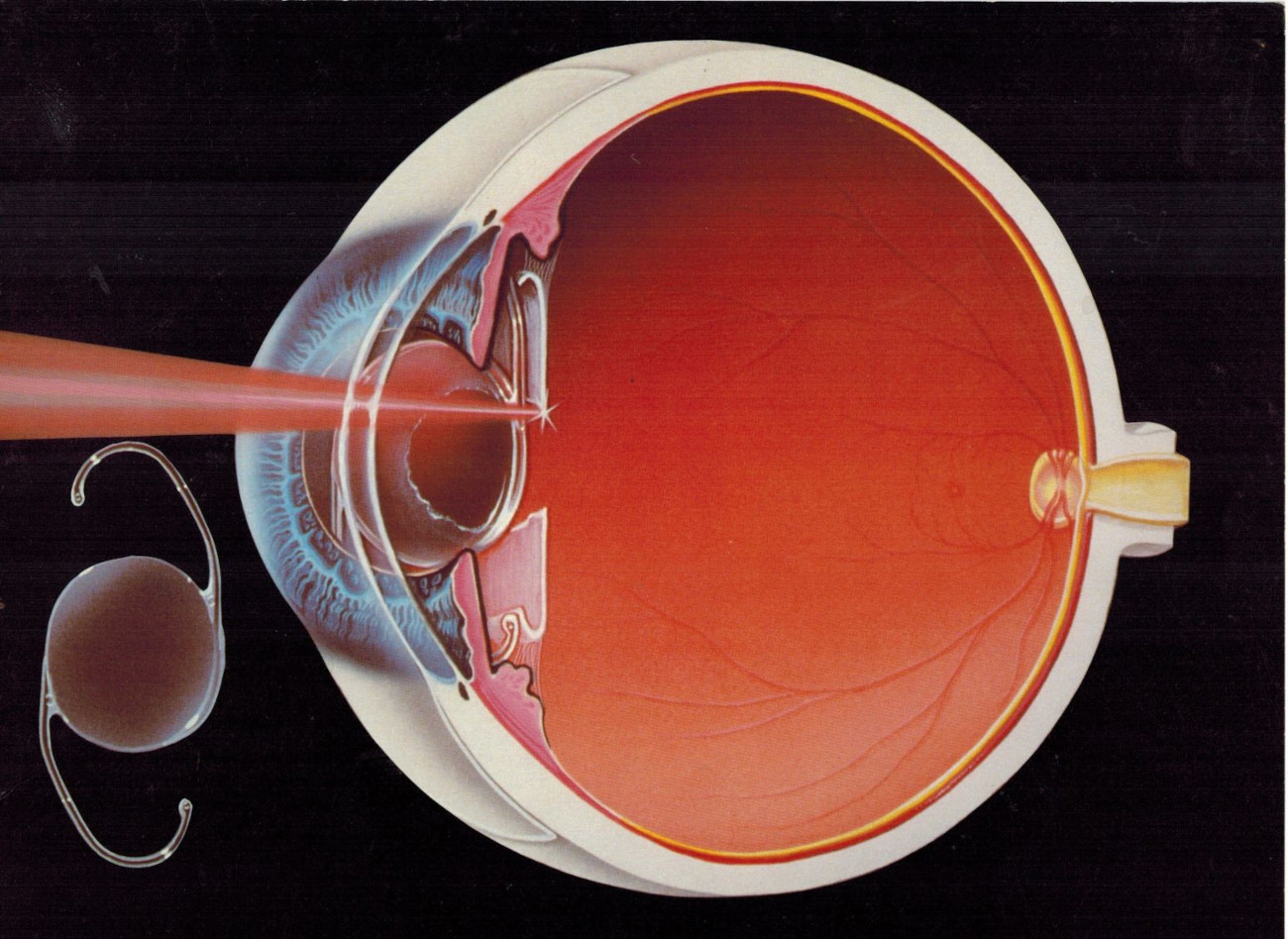 Баня после катаракты. Лазерная дисцизия вторичной катаракты. Катаракта от лазерного излучения. Дисцизия вторичной катаракты техника.