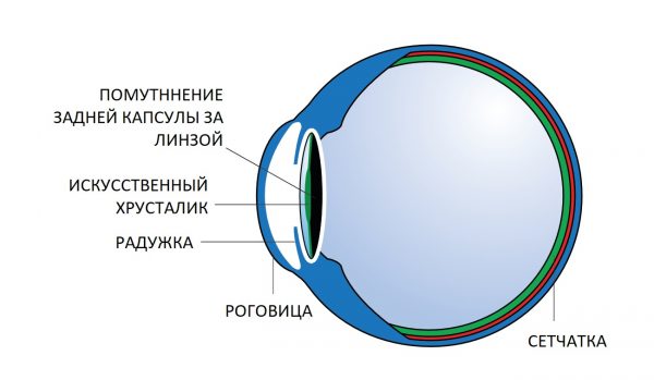 Вторичная катаракта (фиброз задней капсулы хрусталика)