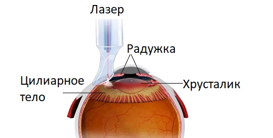 Принцип циклофотокоагуляции при глаукоме
