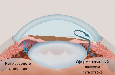 Открытоугольная и закрытоугольная глаукома