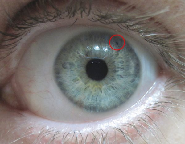 Глаз после ириэктомии (увеличено)