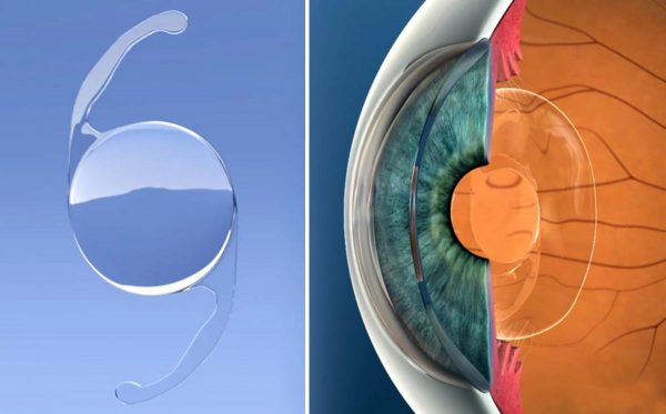 Вид и положение искусственного хрусталика в глазу