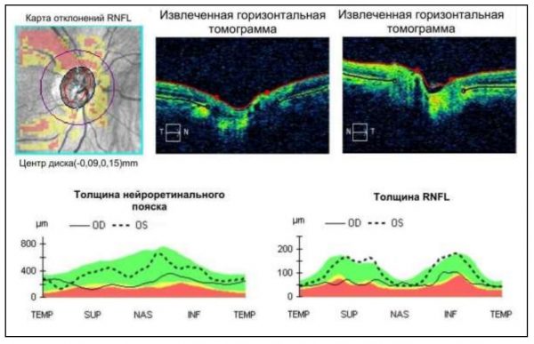 Оптическая когерентная томография диска зрительного нерва при глаукоме