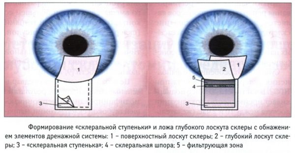 Схема непроникающей операции при глаукоме