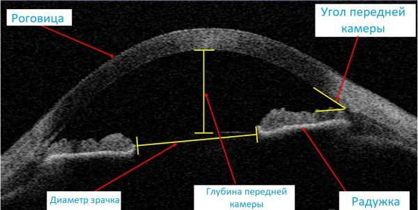 Рис.2 Схема угла передней камеры глаза на снимке ОКТ (оптической когерентной томографии)