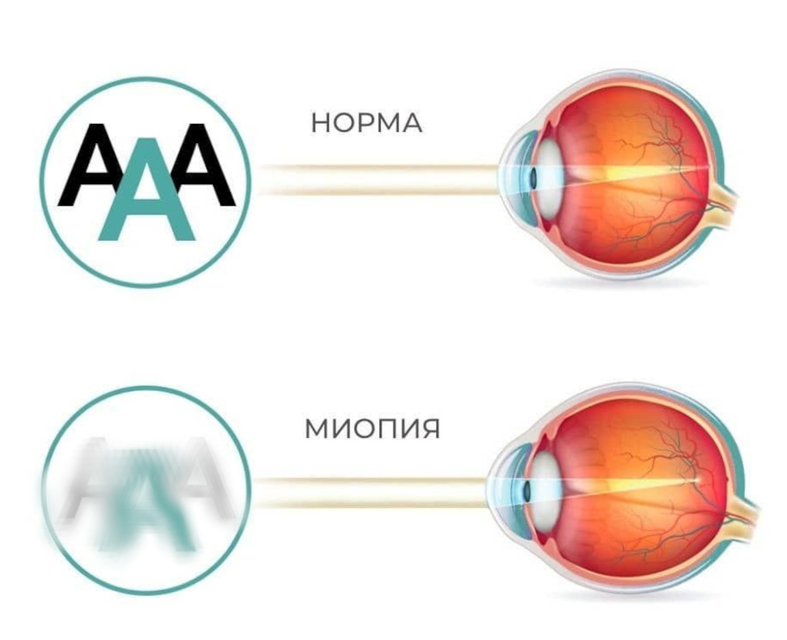 Анизометропия это в офтальмологии. Близорукий глаз. Близорукость и дальнозоркость. Причины миопии. 7. Причины близорукости..