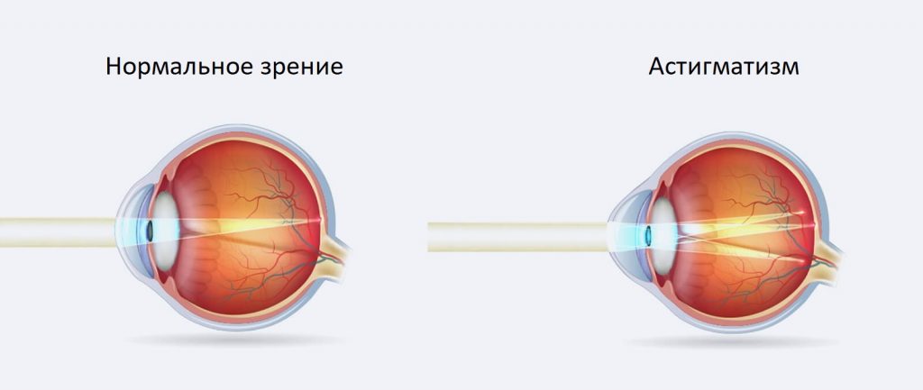 Астигматизм - причины, симптомы, диагностика и лечение - Retina