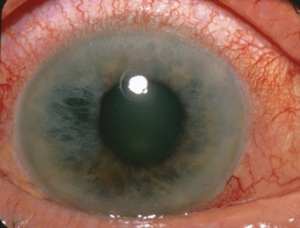 Внешний вид глаза при остром приступе глаукомы (гиперемия конъюнктивы, отек роговицы)