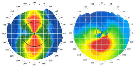 Снимки кератотопографии регулярного (слева) и нерегулярного (справа) астигматизма при кератоконусе