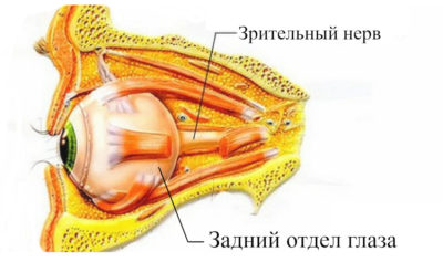 Ишемическая нейропатия (невропатия) зрительного нерва