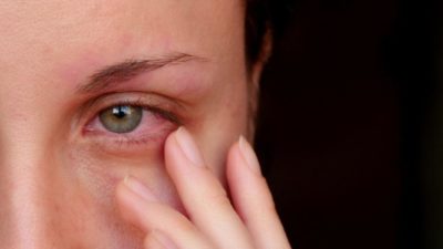 Кератит — воспаление роговицы глаза